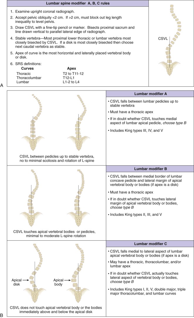 Scoliosis | Musculoskeletal Key