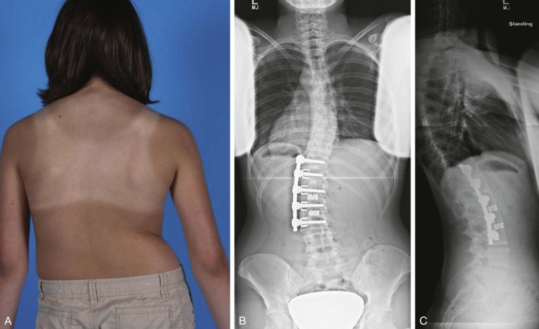 Scoliosis | Musculoskeletal Key