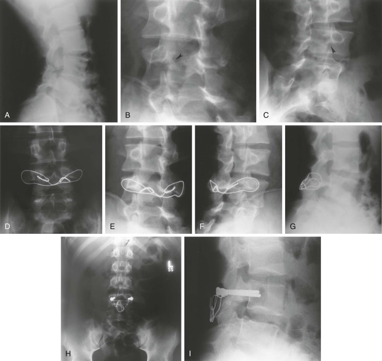 Other Anatomic Disorders Of The Spine | Musculoskeletal Key