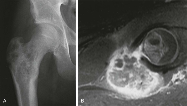 Infections Of The Musculoskeletal System | Musculoskeletal Key