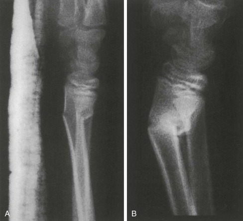 General Principles Of Managing Orthopaedic Injuries | Musculoskeletal Key