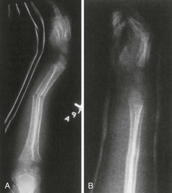 General Principles Of Managing Orthopaedic Injuries | Musculoskeletal Key