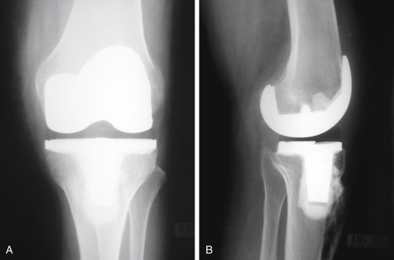 Principles Of Revision Total Knee Arthroplasty | Musculoskeletal Key