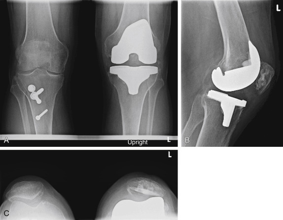 Revision Total Knee Arthroplasty | Musculoskeletal Key