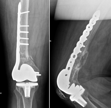 Periprosthetic Fractures Associated With Total Knee Arthroplasty ...