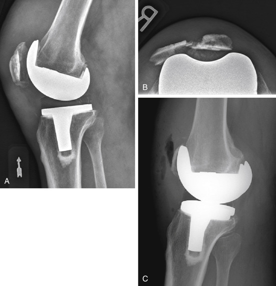 Classification And Treatment Of Patella Fractures | Musculoskeletal Key