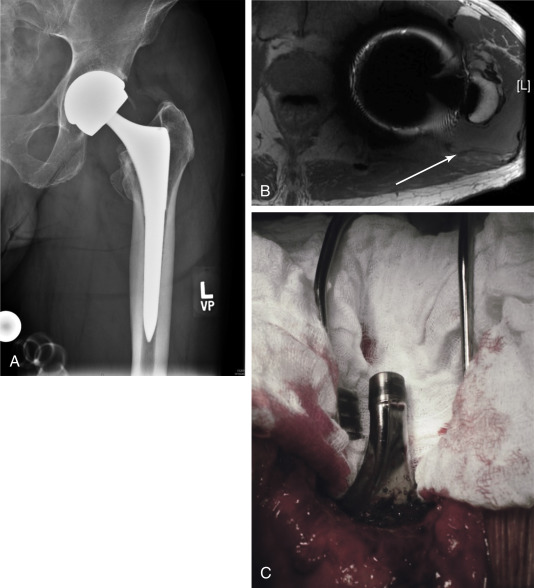 Mechanisms Of Failure: Indications For Revision Total Hip Arthroplasty ...