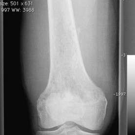 Lymphoma | Musculoskeletal Key