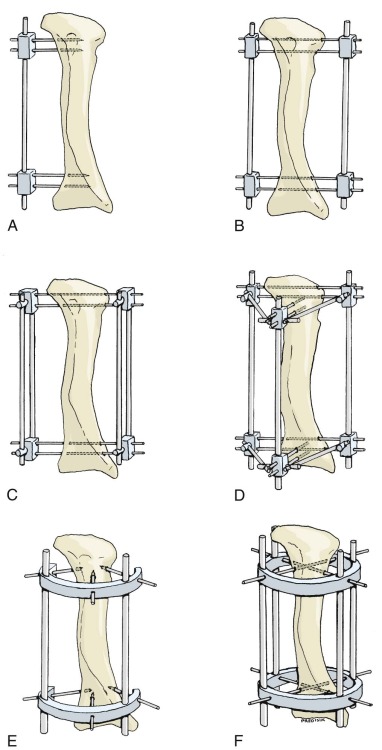 Principles And Complications Of External Skeletal Fixation ...