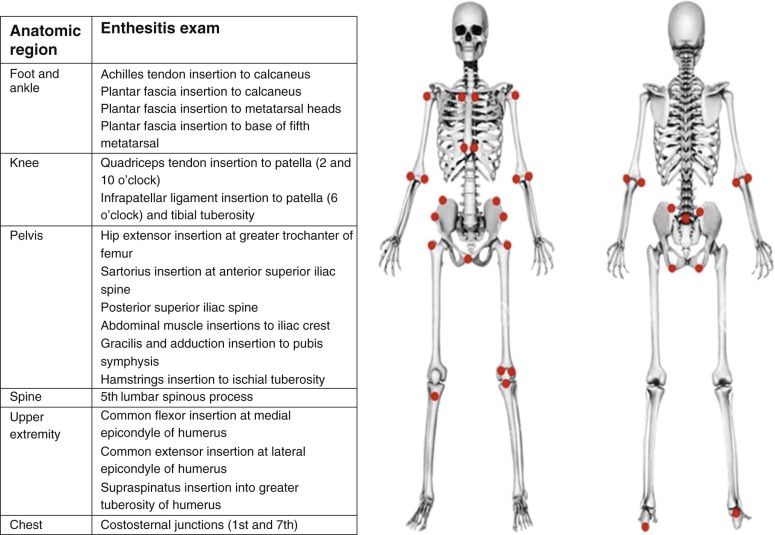 Enthesitis Related Arthritis | Musculoskeletal Key