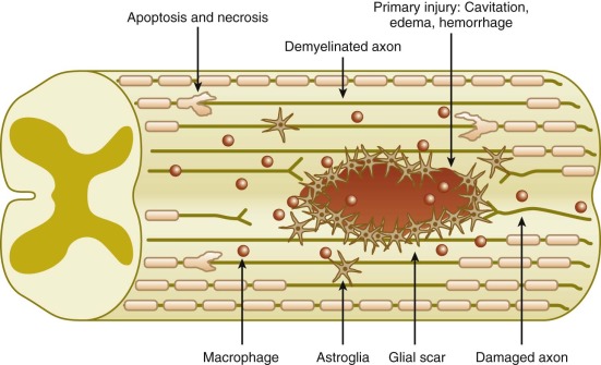 Pathophysiology And Emergent Treatment Of Spinal Cord Injury ...