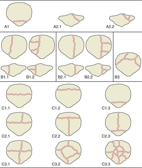 Patella Fracture Classification