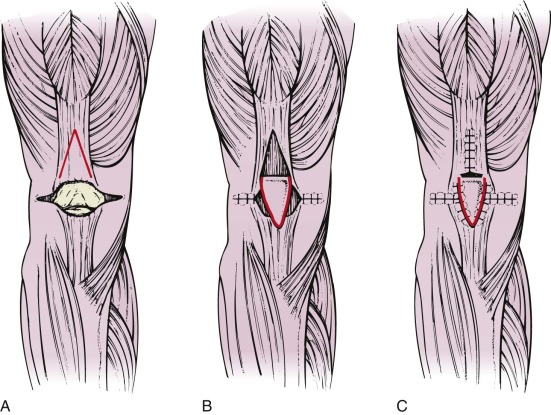 Patella Fractures And Extensor Mechanism Injuries | Musculoskeletal Key