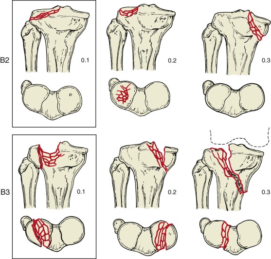 Tibial Plateau Fractures | Musculoskeletal Key