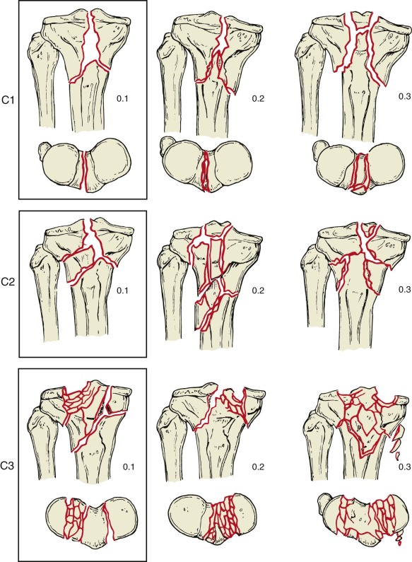 Tibial Plateau Fractures | Musculoskeletal Key