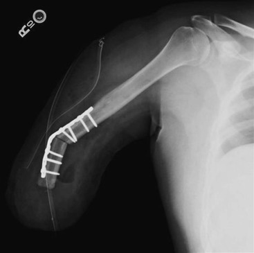 Amputations In Trauma | Musculoskeletal Key