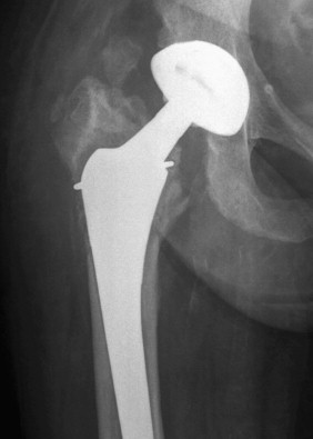 Radiologic Evaluation Of Hip Arthroplasty | Musculoskeletal Key