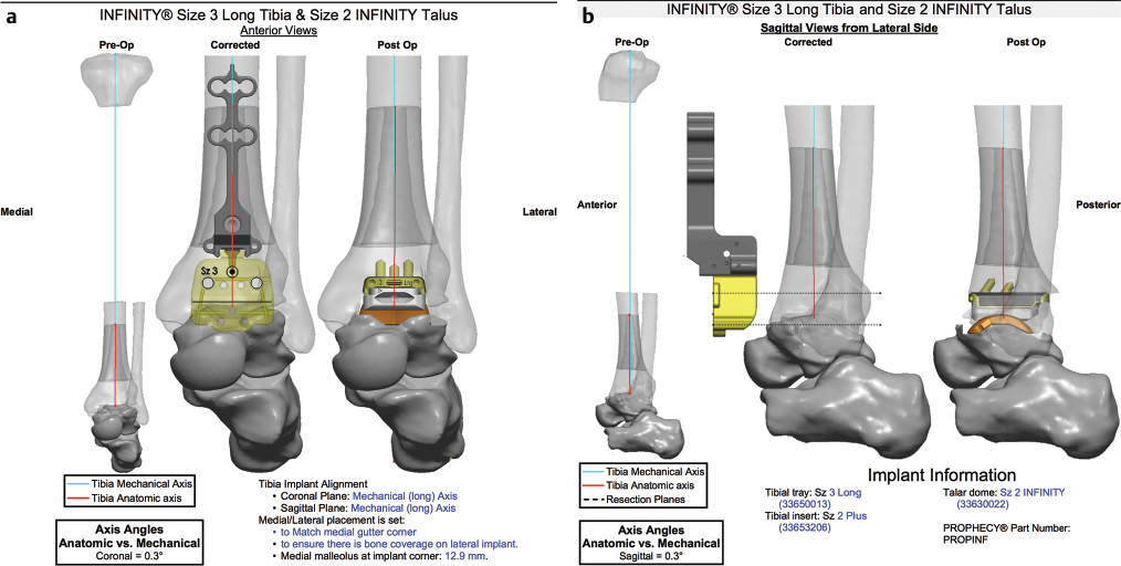 INFINITY/Prophecy Total Ankle Arthroplasty | Musculoskeletal Key