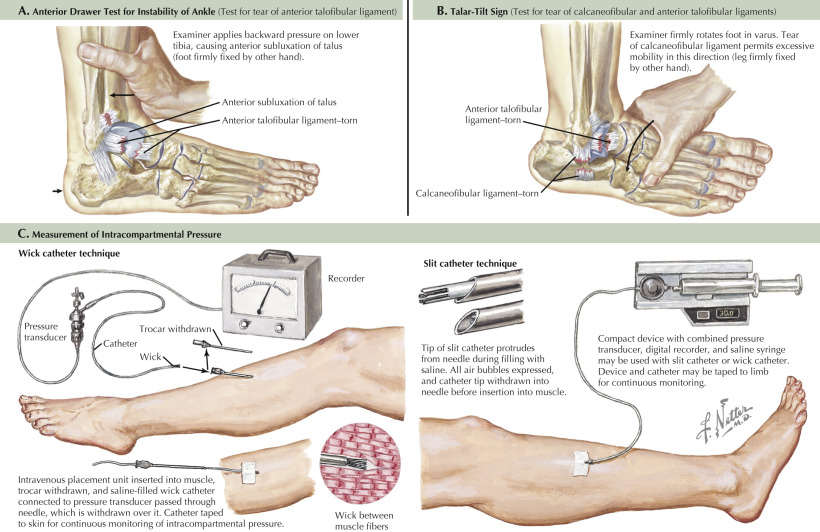 Ankle And Leg Injuries | Musculoskeletal Key