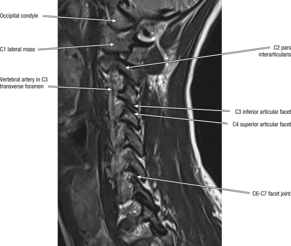 Magnetic Resonance Imaging Of The Cervical Spine | Musculoskeletal Key