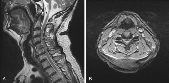 Cervical Spondylotic Myelopathy | Musculoskeletal Key