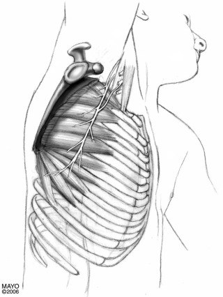 Scapular Winging | Musculoskeletal Key