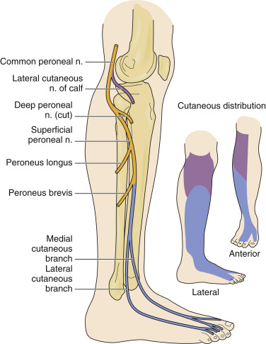 Fibular (Peroneal) Neuropathy | Musculoskeletal Key