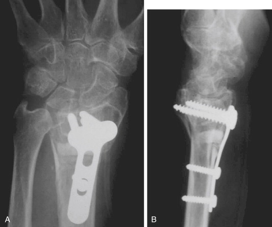 Osteotomies For Distal Radius Malunions: Intra- And Extra-articular ...