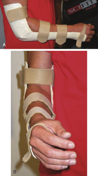 Rehabilitation Of Distal Radius Fractures | Musculoskeletal Key