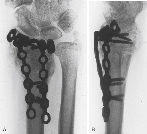 Osteotomies For Distal Radius Malunions: Intra- And Extra-articular ...