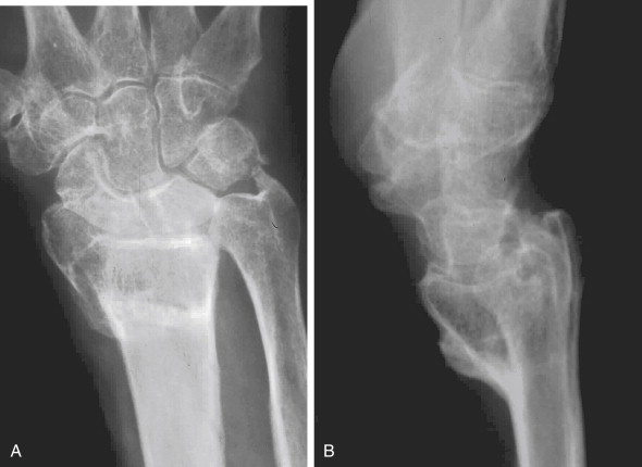 Osteotomies For Distal Radius Malunions: Intra- And Extra-articular ...