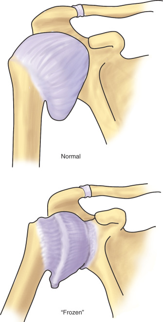 Adhesive Capsulitis (Frozen Shoulder) | Musculoskeletal Key