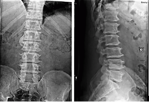 Lumbar Laminectomy | Musculoskeletal Key