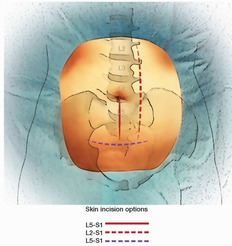 Anterior Lumbar Interbody Fusion | Musculoskeletal Key