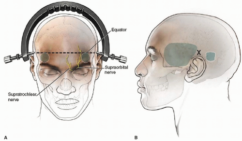 Application Of Gardner-Wells Tongs, Mayfield Head Holder, And Halo ...