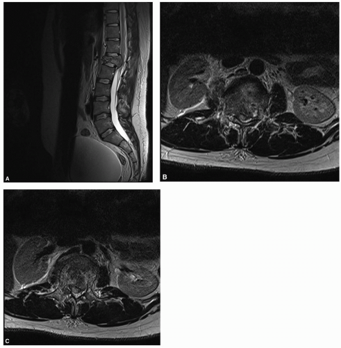 Operative Treatment Of Thoracolumbar Burst Fractures | Musculoskeletal Key