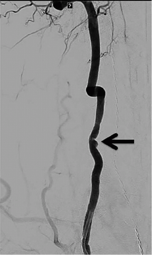 Vertebral Artery Injury | Musculoskeletal Key