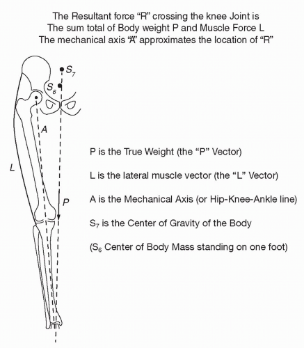 Why Osteotomy For Patellar Instability? | Musculoskeletal Key