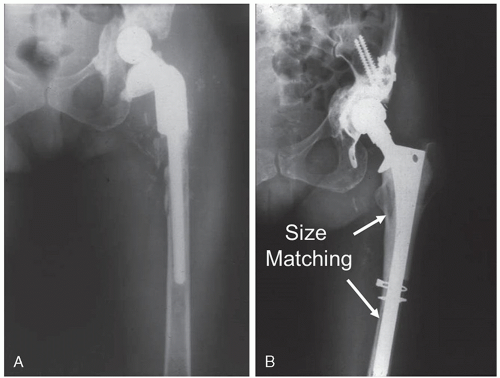 Allograft Prosthetic Composite | Musculoskeletal Key