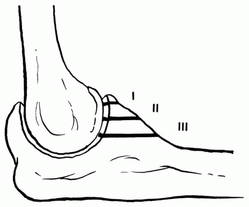 Trauma | Musculoskeletal Key