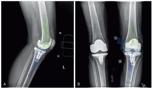 Preoperative Evaluation, Planning, And Templating For Revision Total ...