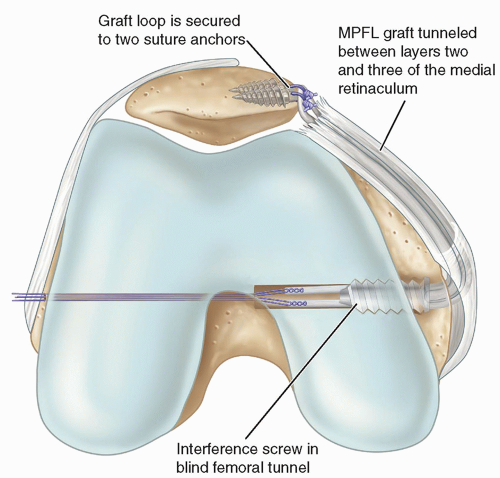 Medial Patellofemoral Ligament Reconstruction Using Bone Tunnels ...