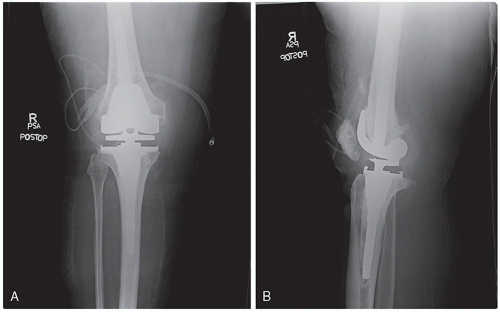 Patellar Instability | Musculoskeletal Key