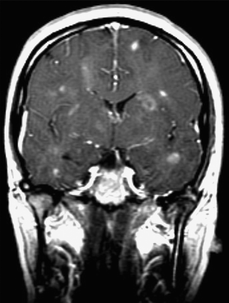 Neurosarcoidosis | Musculoskeletal Key