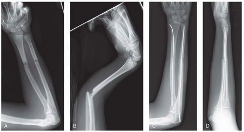 Intramedullary Fixation Of Radial And Ulnar Shaft Fractures In ...