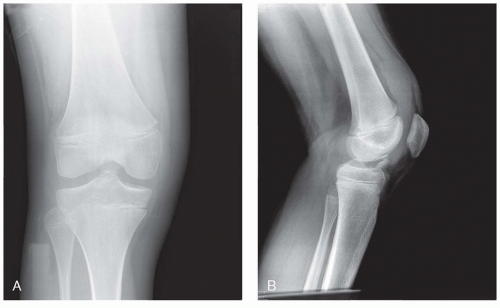 Surgical Reduction And Fixation Of Tibial Spine Fractures In Children ...