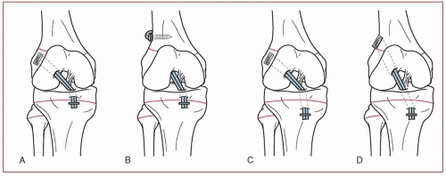 Pediatric Anterior Cruciate Ligament Reconstruction | Musculoskeletal Key