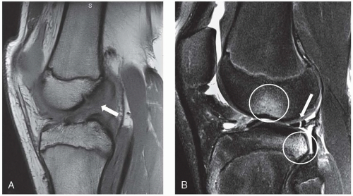 Pediatric Anterior Cruciate Ligament Reconstruction | Musculoskeletal Key