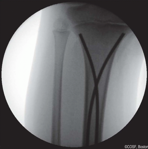 Flexible Intramedullary Nailing Tibia | Musculoskeletal Key