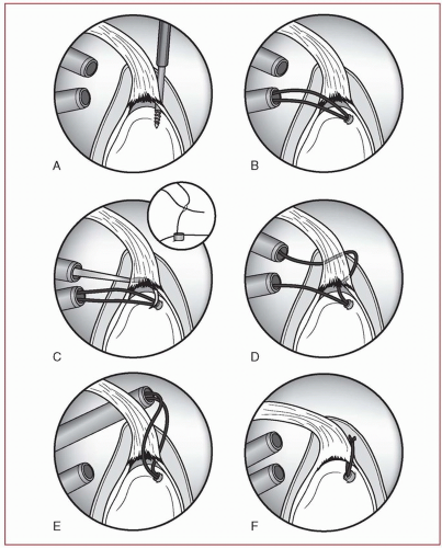 Arthroscopic Superior Labrum Anterior-to-Posterior Repair ...